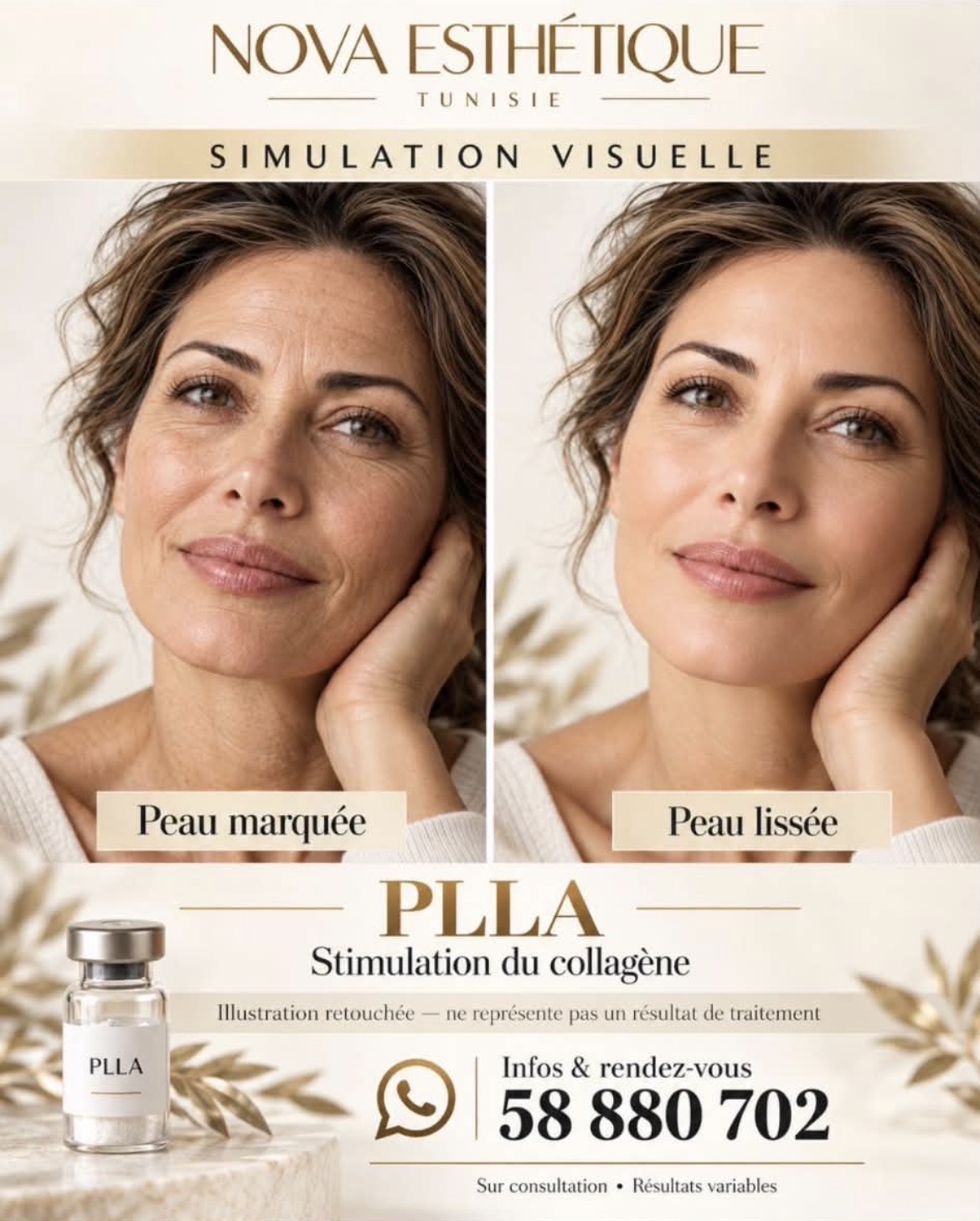 PLLA : peau marquée et peau lissée (simulation)